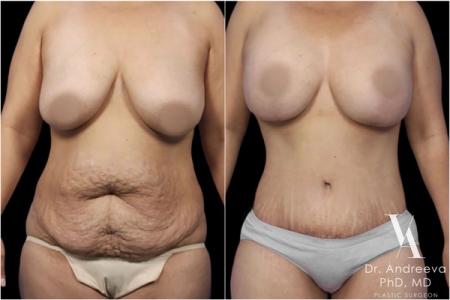 липосакция