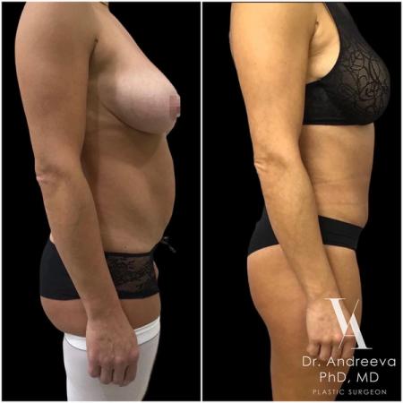 липосакция