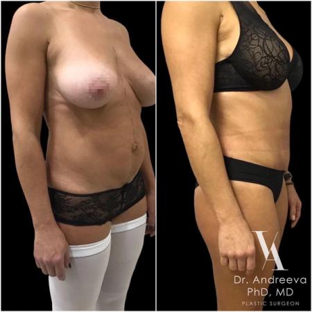 липосакция