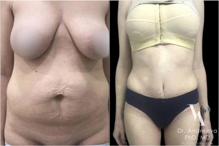 липосакция