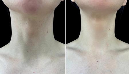 феминизация