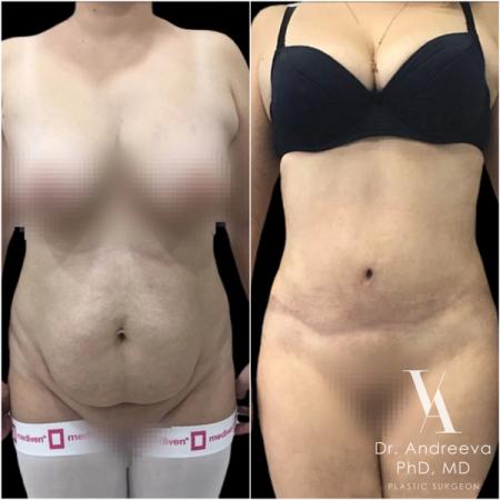 липосакция