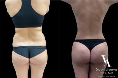 липосакция