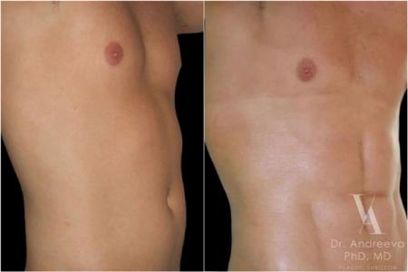 липосакция