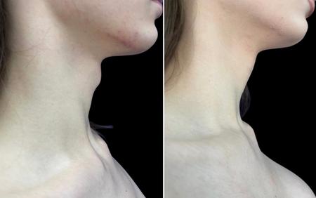 феминизация