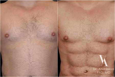 липосакция