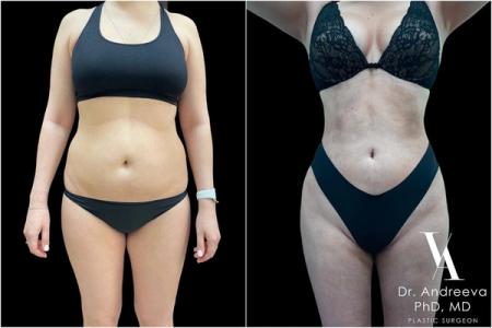 липосакция