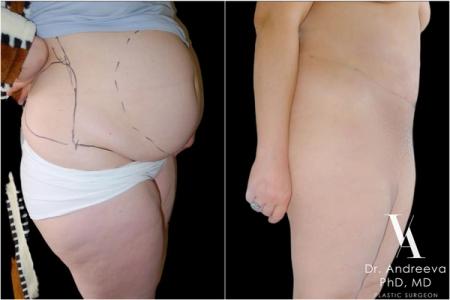  липосакция