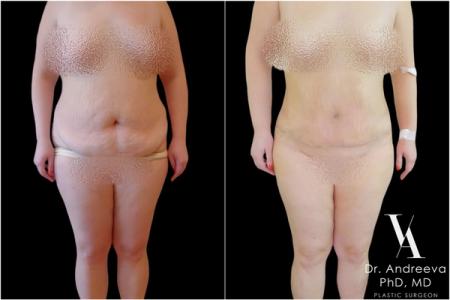 липосакция