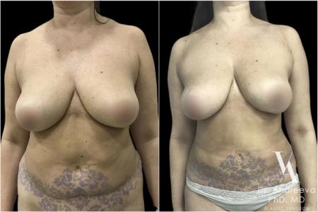 липосакция