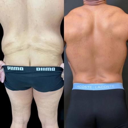 липосакция