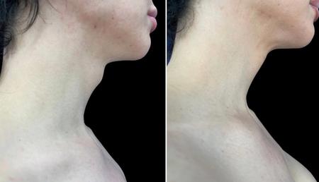 феминизация