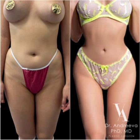 липосакция liposuction