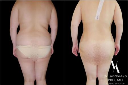 липосакция