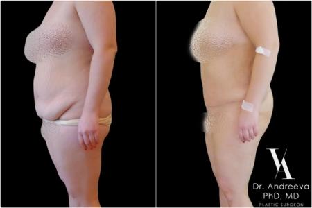 липосакция