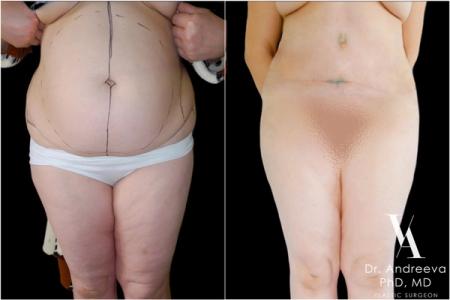 липосакция