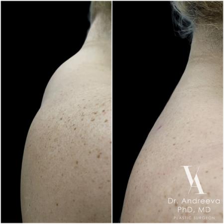 липосакция