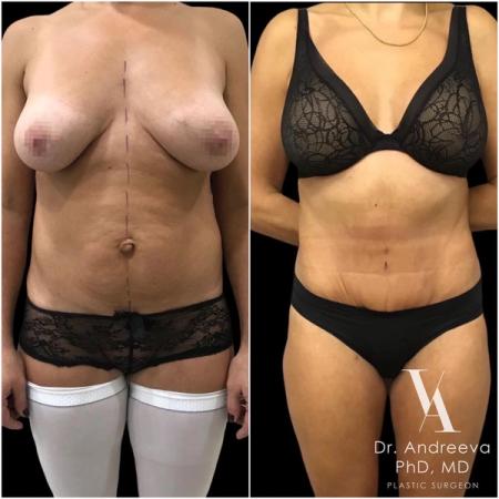 липосакция