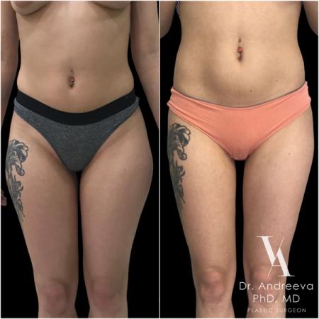 липосакция