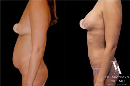 липосакция