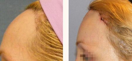 феминизация