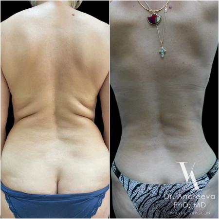 липосакция