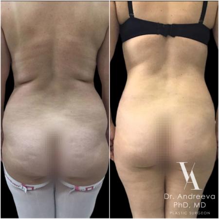 липосакция