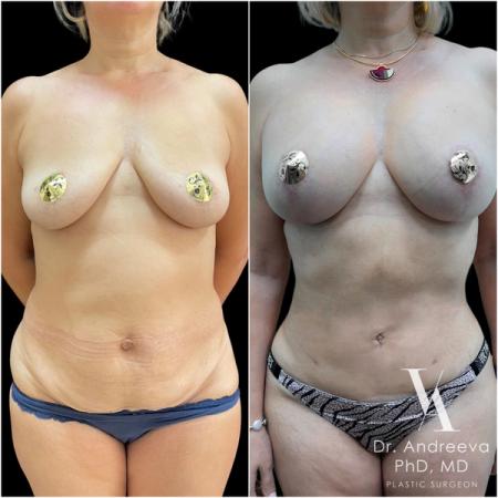 липосакция