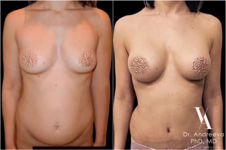 липосакция