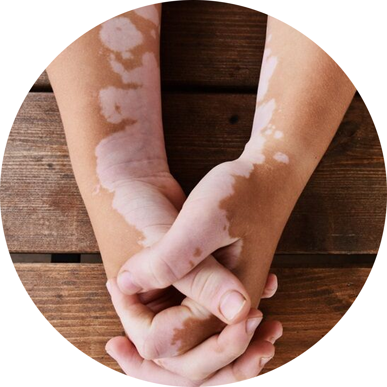 autoimmune disorder
