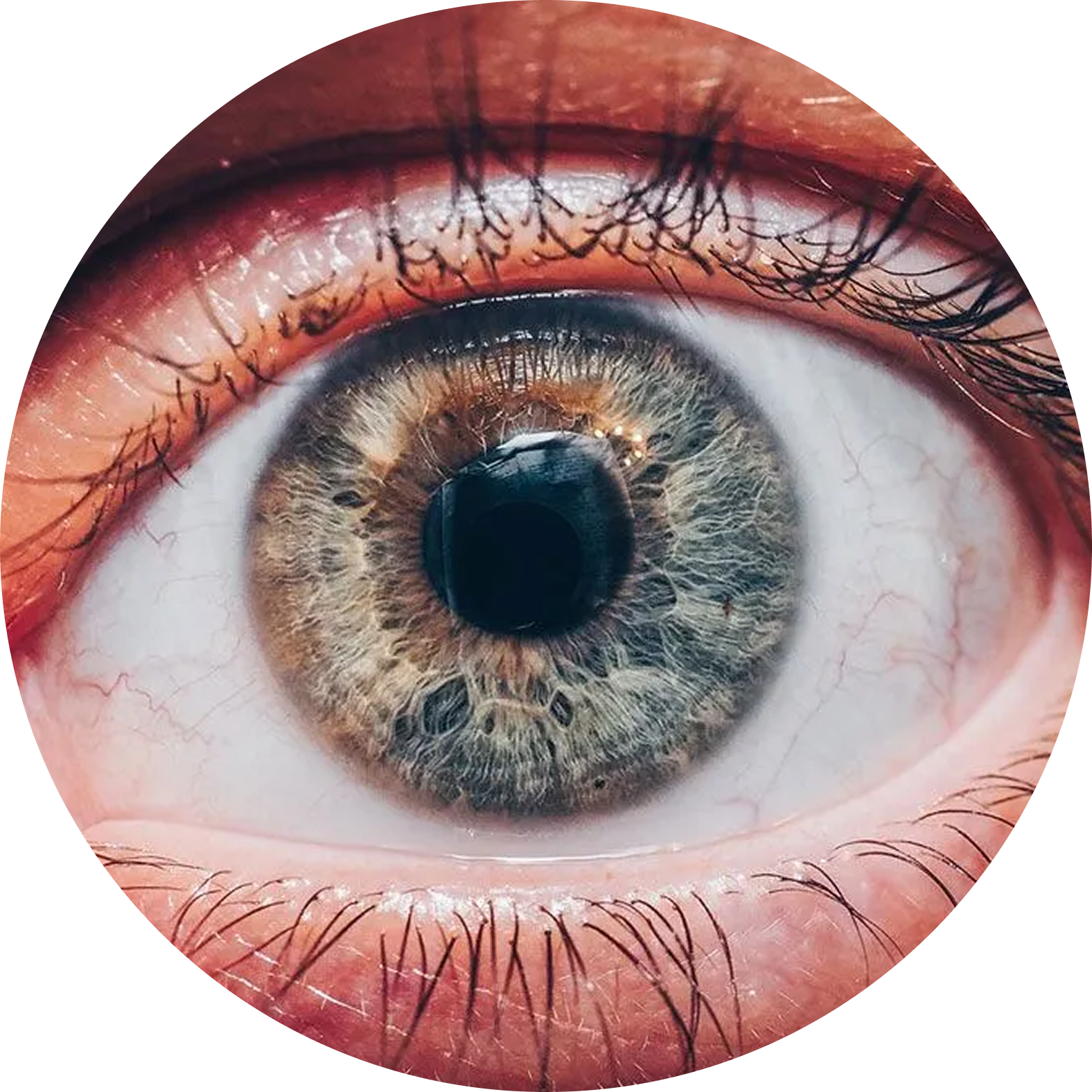 optic neuritis
