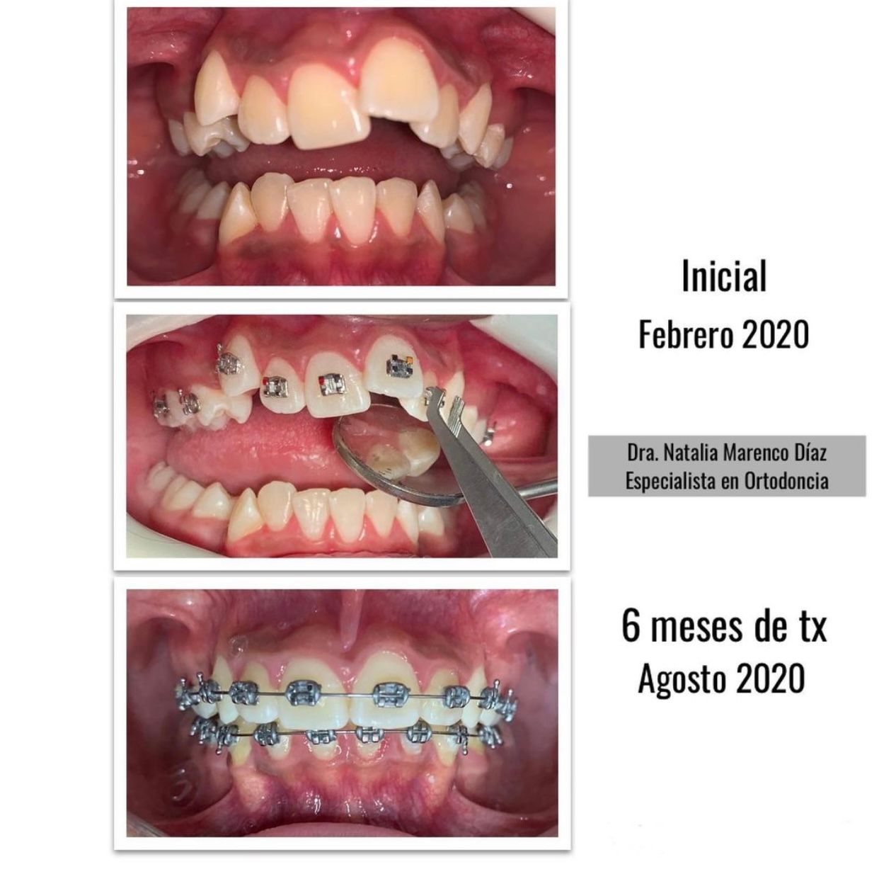 Ortodoncia 6 meses de tx