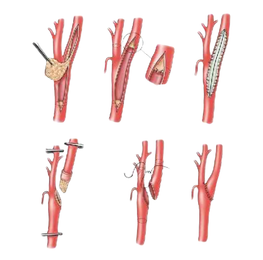 tecnica abierta de endarterectomia