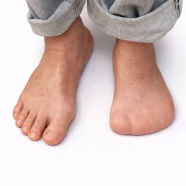 Piernas descalzas y amputación parcial