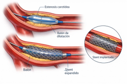 Tratamiento de estenosis carotídea con stent