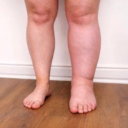 Desigualdad en las piernas por linfedema_1_1