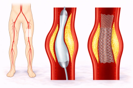 Intervención vascular y angioplastia