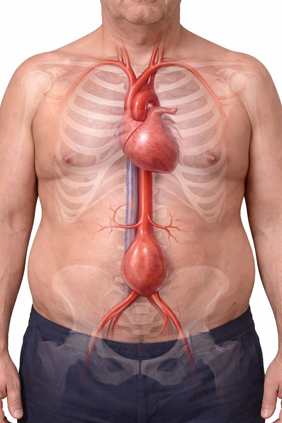 Anatomía interna con aneurisma aórtico