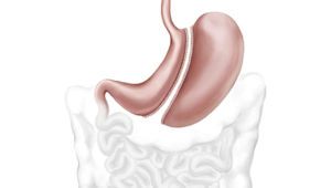 endoscopic sleeve gastroplasty