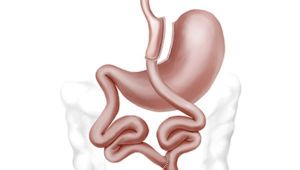 gastric bypass