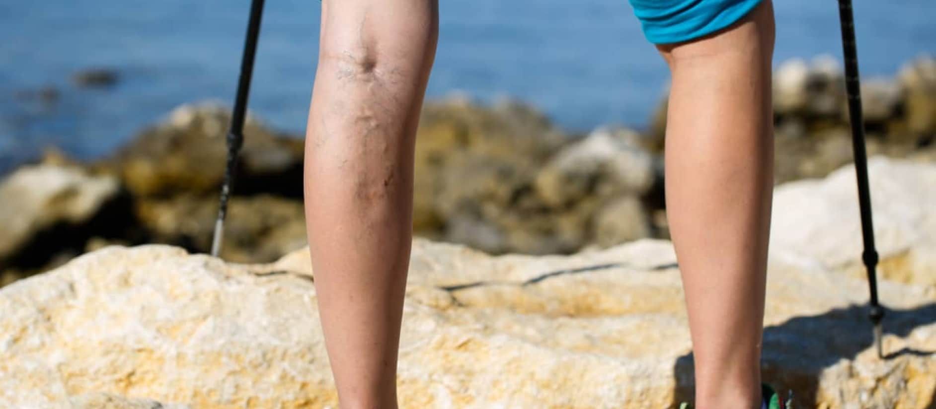 man with varicose veins may seek treatment from specialist