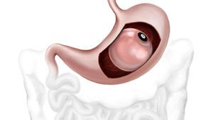 gastric balloon