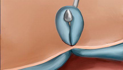 microphleboctamy