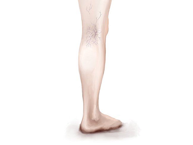 spider veins