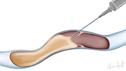 sclerotherapy