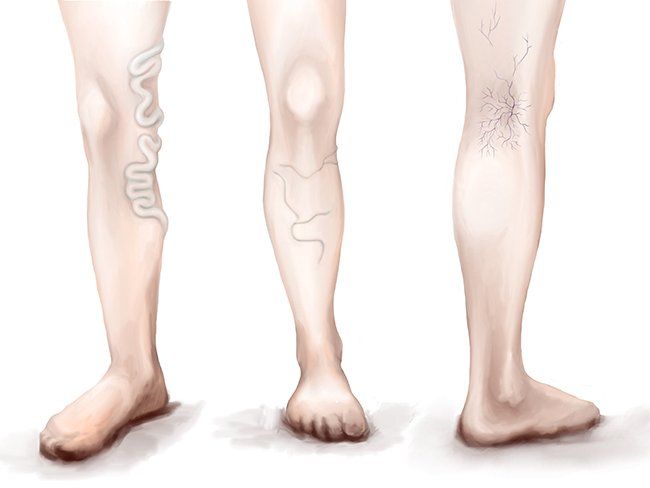 varicose veins