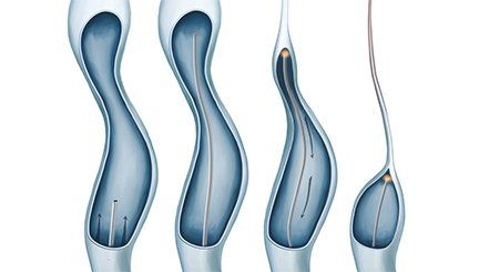 endovenous laser treatment