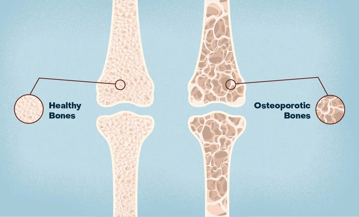 tirzepatide osteoporosis Tips for Preventing Osteoporosis