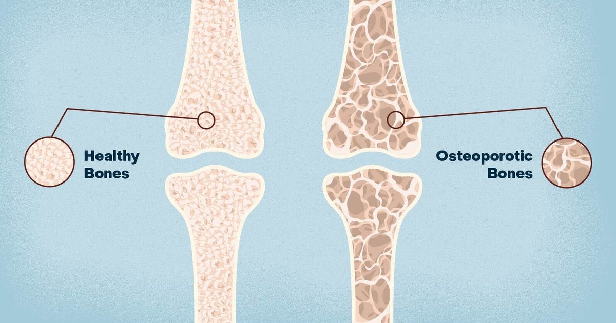Tips for Preventing Osteoporosis Tips for Preventing Osteoporosis