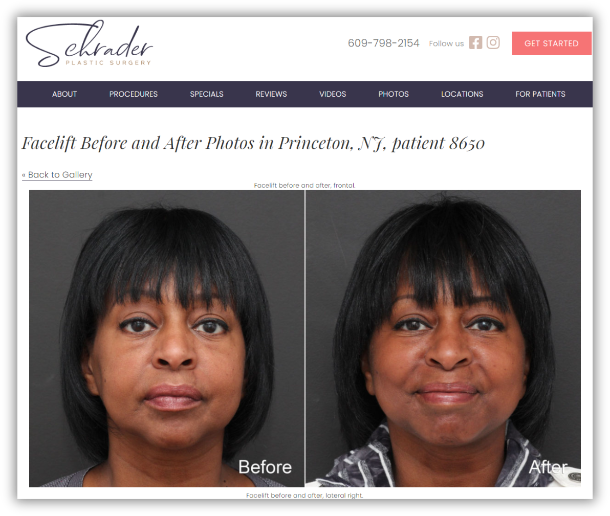 Slender before and after patient photographs